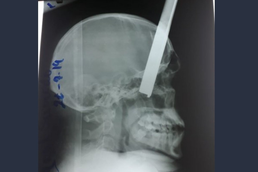 radiografia hombre herido con una varilla cabeza cerebro masa encefalica GENT